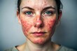 Rosacea or Eczema Management: A portrait of a person managing skin conditions like rosacea or eczema with specialized skincare routines and medical treatments prescribed by healthcare professionals.
