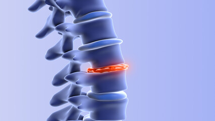 Human spine with degenerative disc