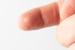 Treatment blister on finger