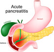 Acute pancreatitis. Pancreas inflammation