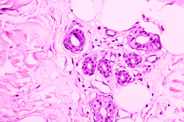 Backgrounds of human cells tissue of cervix under the microscope in pathology lab.View in microscopic of ductal cell carcinoma, adenonocarcinoma from human breast cancer, tissue section by H and E