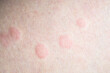Skin allergy rash dermatitis texture close up
