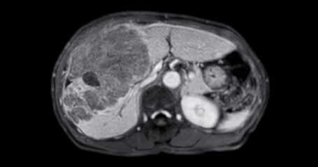 Wall Mural - CT Abdomen show a retroperitoneal mass with a peripheral fatty component with thin septa and poorly defined solid-appearing areas with no clear demarcation between them and fat.