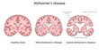 progression of Alzheimer disease, comparing a healthy brain to those with mild and severe Alzheimer structure diagram hand drawn schematic raster illustration. Medical science educational illustration
