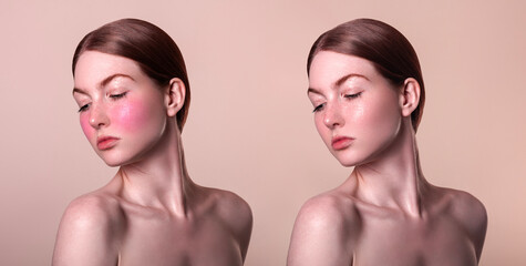 Wall Mural - Rosacea couperose redness skin treatment, before and after result of IPL laser treatment, red spots on cheeks, red-haired woman with sensitive skin, patient face close-up on beige background