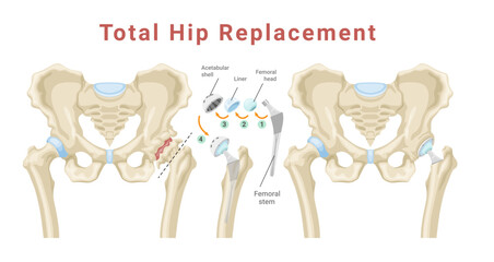 Total hip replacement surgery with anatomical acetabular prosthesis medical poster isometric vector