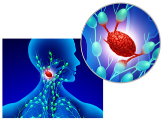 swollen lymph node as an infected gland of the lymphatic system and immune system as a swelling of t