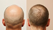 Hair loss concept. Transplantation hair. Man before after hair loss treatment. Comparison of hair before and after transplantation.
