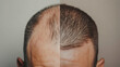 The head of a man before and after hair transplant surgery. Hair loss concept.  Before and After Bald head of hair loss treatment.