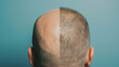 Comparison of hair before and after. Mans head after a hair transplant, on the left has a bald head, while the man on the right has a full head of hair. 