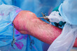 Doctor surgeon preparing patient leg before minimally invasive surgery, laparoscopic instrument for knee of man, operating hospital.