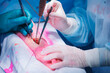 Surgeon installs metal screw pin to fuse radius bones. Surgery to restore patient arm in clinic