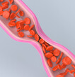 Deep vein thrombosis. 3D rendering