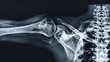 © Fay Melronna  - A detailed Xray of a broken clavicle, providing full clarity on the vertebrae, suitable for effective orthopedic examination and treatment planning