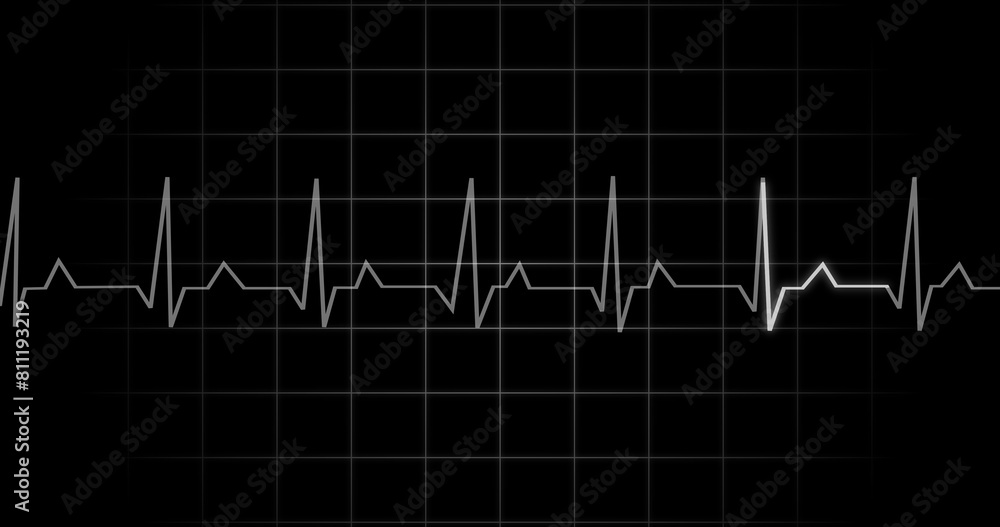 EKG Heartbeat reading animation on black background. Medical monitor ...