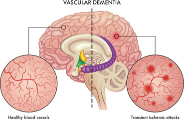 Medical illustration compares healthy blood vessels of the brain, with others affected by transient ischemic attacks which are one of the causes of vascular dementia in the brain.