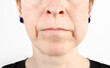 Swollen cheek from wisdom tooth extraction on day 3. Close up of woman with swollen face. Cheek swelling from dental surgery, wisdom teeth removal or tooth infection concept. Selective focus.