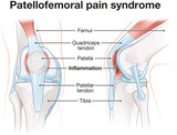 Fototapeta  - Patellofemoral pain syndrome. Patellofemoral joint of the knee. Labeled illustration