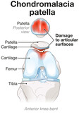 Fototapeta  - Chondromalacia patella. Knee pain. Runner’s knee. Labeled Illustration