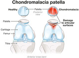 Fototapeta  - Chondromalacia patella. Knee pain. Runner’s knee. Labeled Illustration
