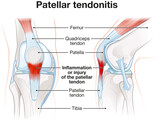 Fototapeta  - Patellar tendonitis. Jumper's knee. Labeled illustration