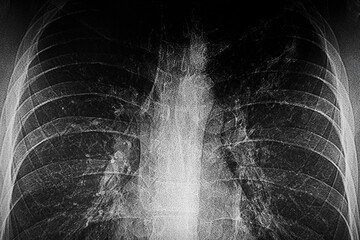 Medical themes: X- ray image of patient  with tuberculosis infection