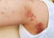 © Rung Kh - Portrait showing the rash hives allergy and inflammation skin, reaction and urticaria, urticaria and acne on the body, health care and medical concept.