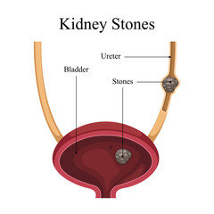 internal organ vector diagram of kidney stone disease