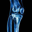 © ketkata - X-ray image of the knee bone, generative ai