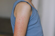 © ZheniaSarafanov - Children's allergies. a boy of European appearance with the first signs of the virus, red spots on his body. Allergy in the hands of a child