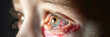 © Daniel - red eye of a patient with human conjunctivitis, ill allergic eyes in babies, children