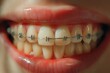 © Wirestock - an open mouth with some clear braces on her teeth