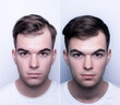 © Cantarela - Collage of 2 photos a man with a hair loss problem before and after treatment, anti-hair loss procedures, hair transplant, on a gray background, collage. Appointment with a trichologist..