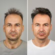 © sema_srinouljan - a man with hair loss before and after the treatment