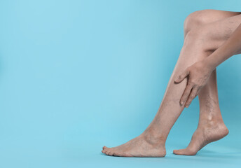 Wall Mural - Closeup view of woman suffering from varicose veins on light blue background. Space for text