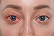 © New Africa - Woman with red eye suffering from conjunctivitis, closeup