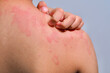 © Tanapat Lek,jew - Skin texture suffering severe urticaria or hives or kaligata. Allergy symptoms.