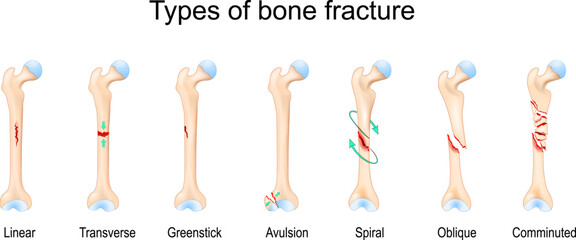 Poster - Types of bone fracture. Femur bone.