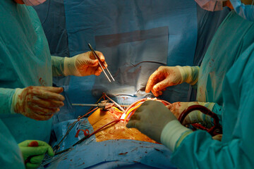 An operating room is used for performance heart surgery by team of doctors