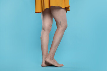 Canvas Print - Closeup view of woman with varicose veins on light blue background