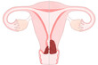 © koyuki - Blank cervical cancer stage 1B diagram PNG