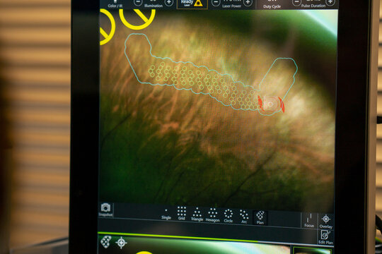 close-up of a diagnostic screen with an image of the eye indicator of moisture and dry areas check