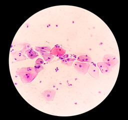 Sticker - Atypical squamous cells of undetermined significance, it may be a sign of infection with certain types of human papillomavirus (HPV) or other types of infection, such as a yeast infection.