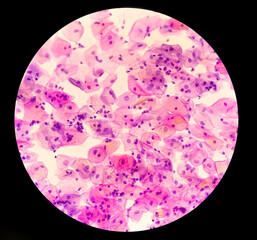 Poster - Atypical squamous cells of undetermined significance, it may be a sign of infection with certain types of human papillomavirus (HPV) or other types of infection, such as a yeast infection.