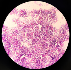 Poster - Atypical squamous cells of undetermined significance, it may be a sign of infection with certain types of human papillomavirus (HPV) or other types of infection, such as a yeast infection.