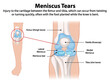 © GraphicsRF - Illustration of knee meniscus tear anatomy
