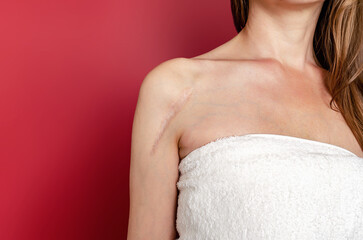 Wall Mural - Scar after surgery on a woman shoulder on red background