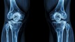 © Ndoomyim - X-ray image of two healthy human knees, showcasing the bone structure and joint.