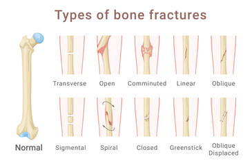 Wall Mural - Types of femoral shaft bone fracture medical scheme infographic isometric vector illustration