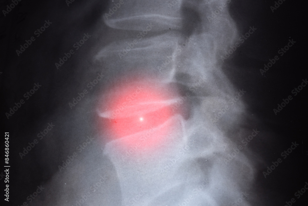 X-ray and MRI, MRT, CT with the human spine with defects in bones and ...